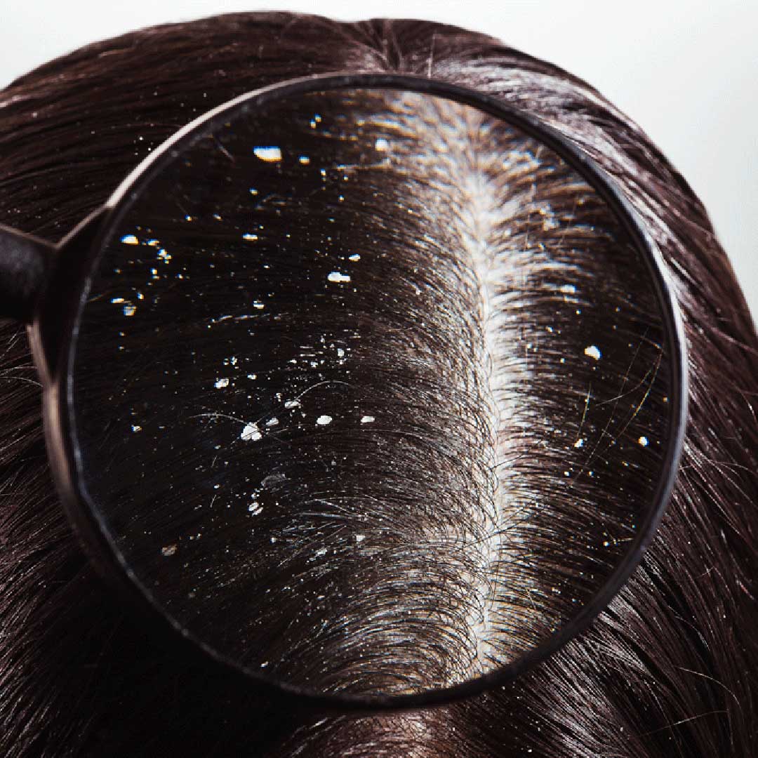 Get Rid of Dandruff