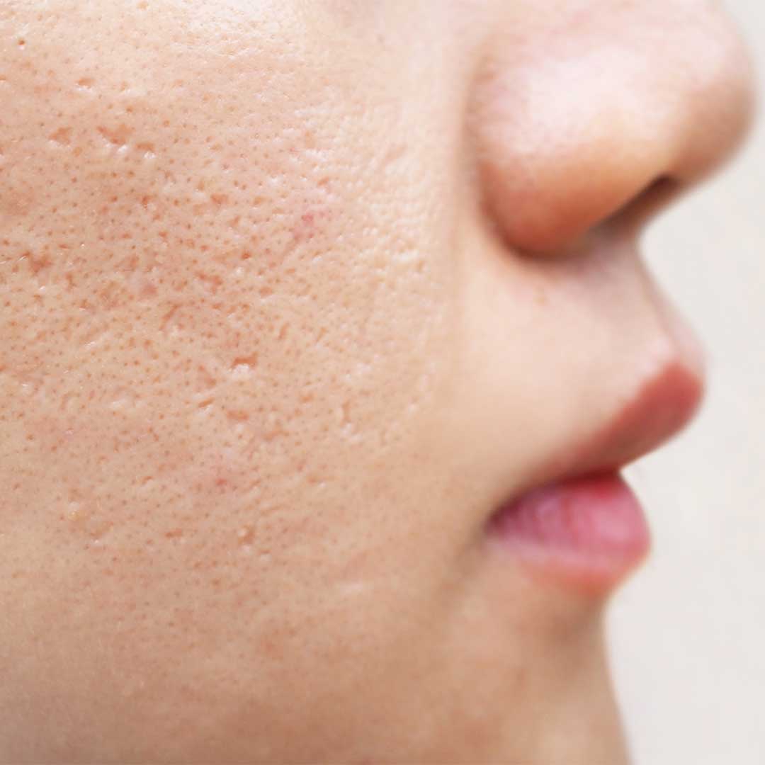 blackheads