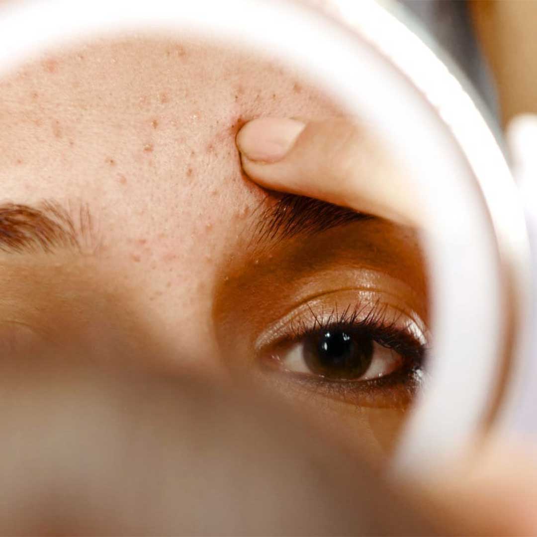 Get Rid of Clogged Pores