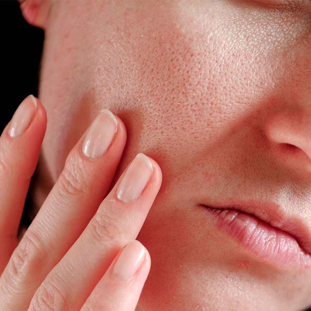 Home Remedies For Open Pores On Skin